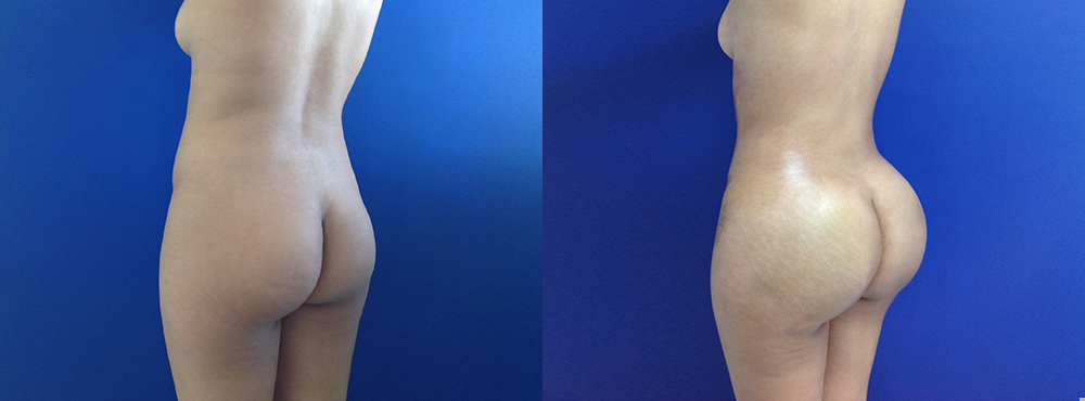 BBL Before and After