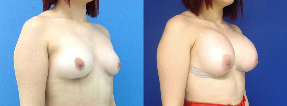 Breast Augmentation Before and After