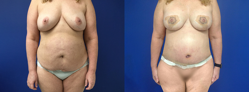 Mommy Makeover Before and After
