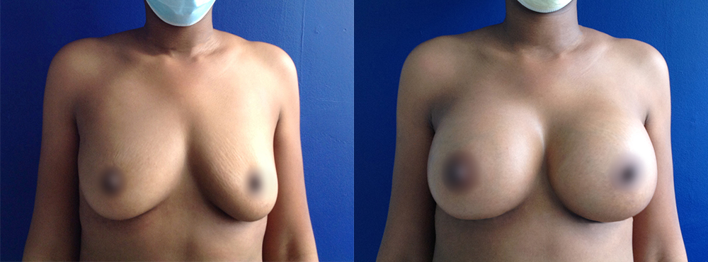  Breast Augmentation Before and After