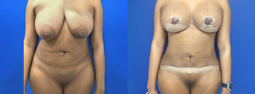 Mommy Makeover Before and After