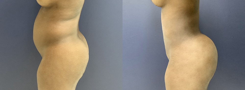 BBL Before and After