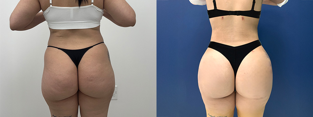 Butt Lift Before and After in miami