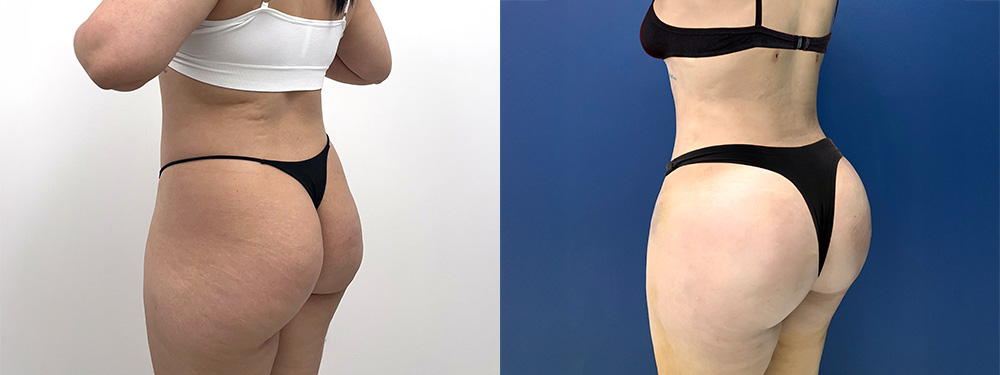 Butt Lift Before and After in miami