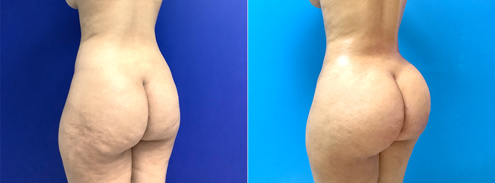 BBL Before and After