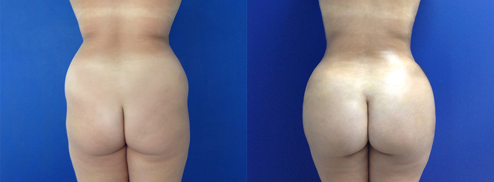 BBL Before and After