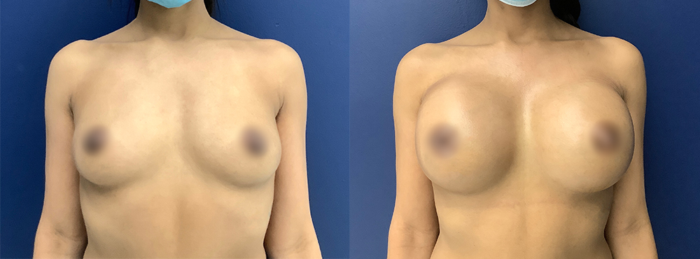 Breast Augmentation  Before and After