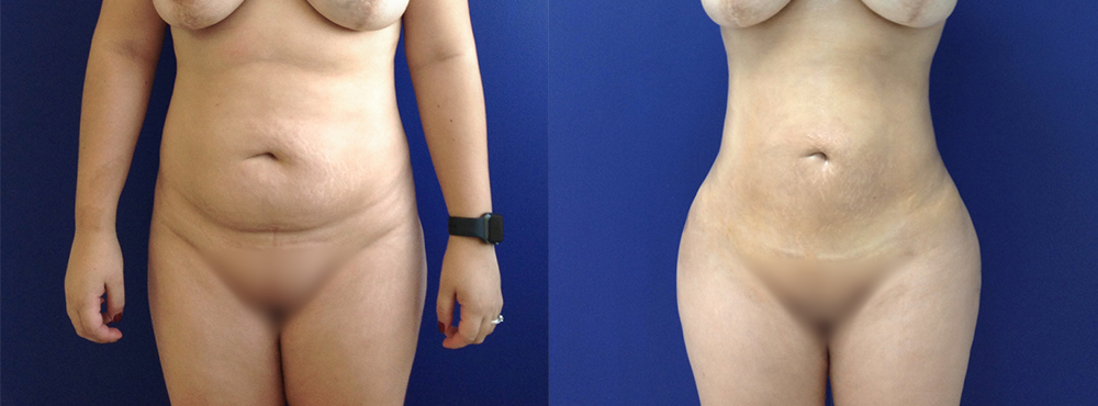 BBL Before and After