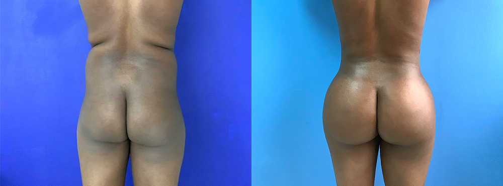 BBL Before and After