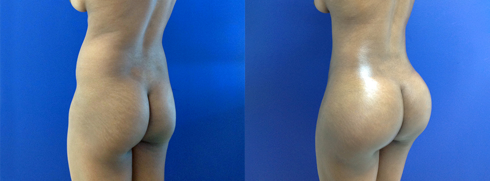 BBL Before and After