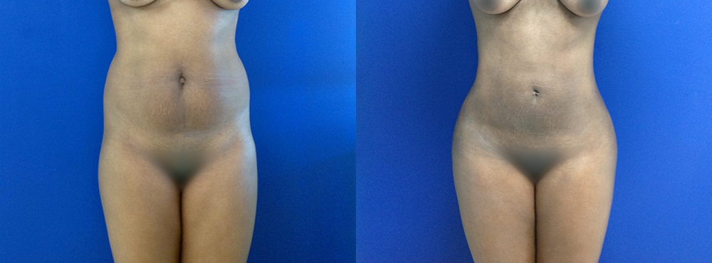 BBL Before and After