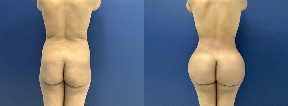 BBL Before and After