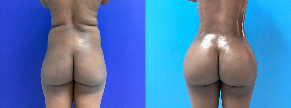 BBL Before and After