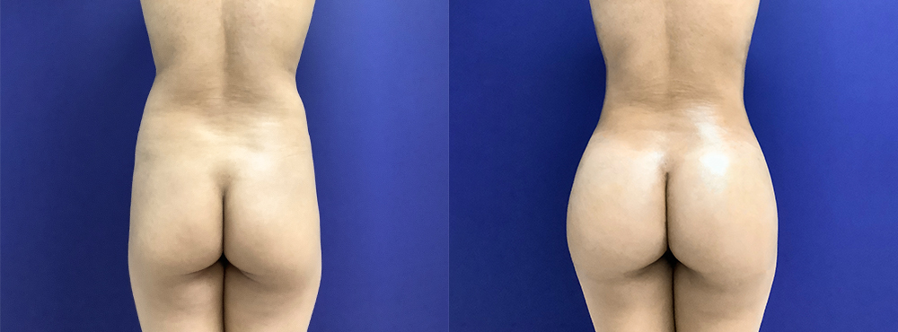 BBL Before and After