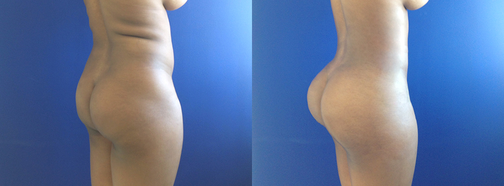 BBL Before and After