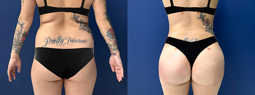 Brazilian Butt Lift Before and After