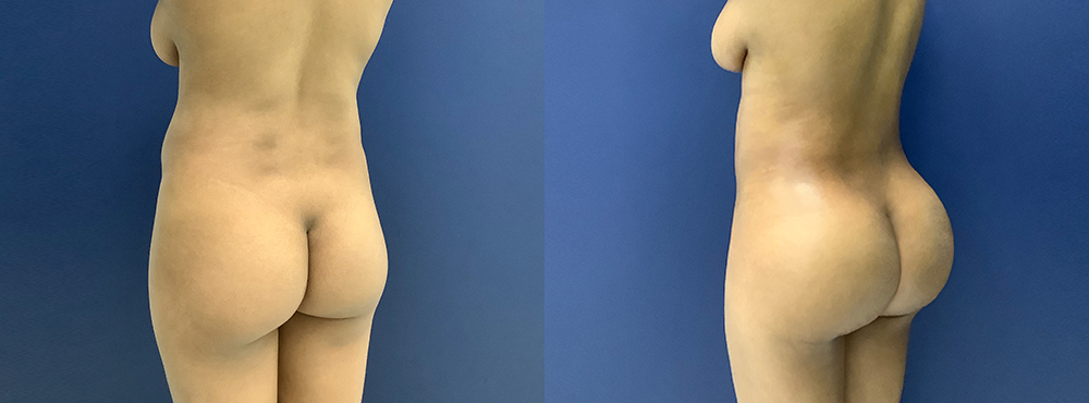 BBL Before and After