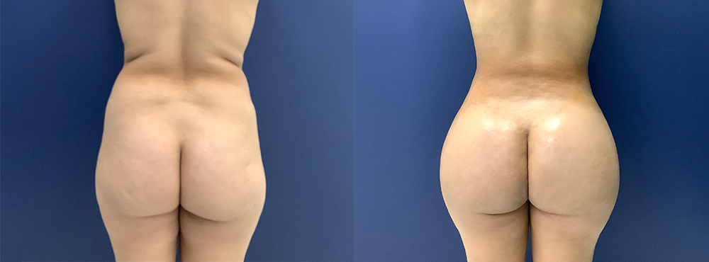 BBL Before and After