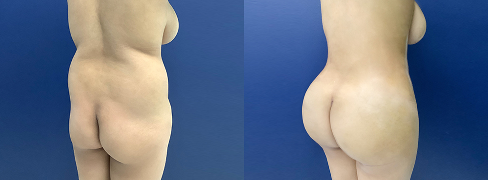 BBL Before and After