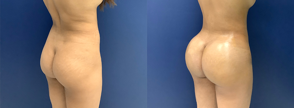 BBL Before and After