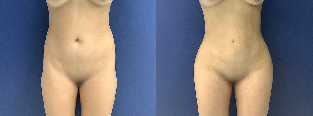 BBL Before and After