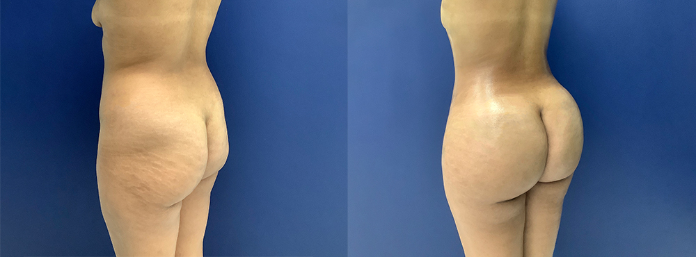 BBL Before and After