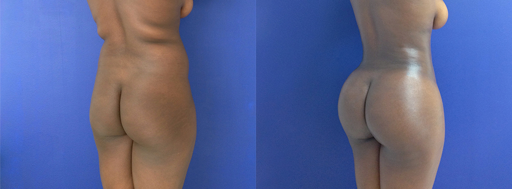 BBL Before and After