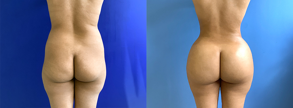 BBL Before and After