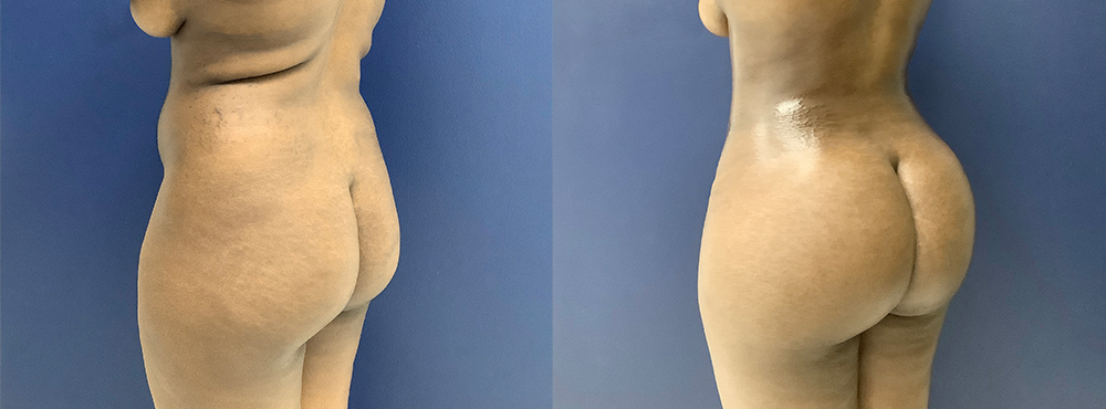 BBL Before and After