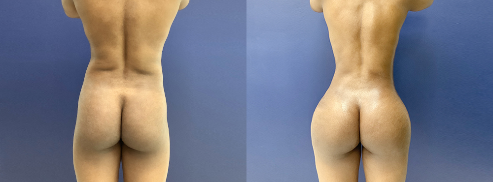 BBL Before and After