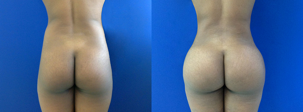 BBL Before and After