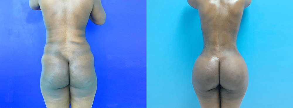 BBL Before and After