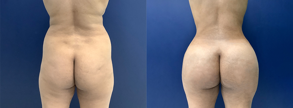 BBL Before and After