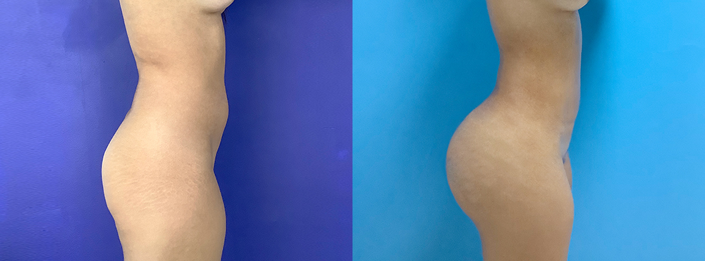 BBL Before and After