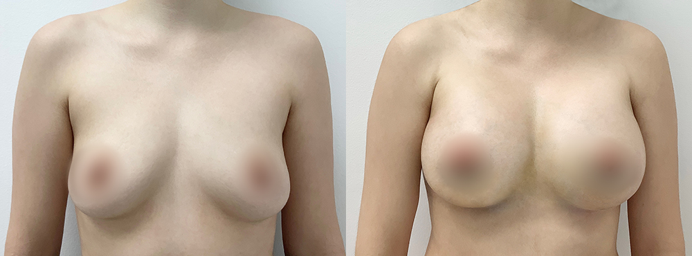 Breast Augmentation Before and After