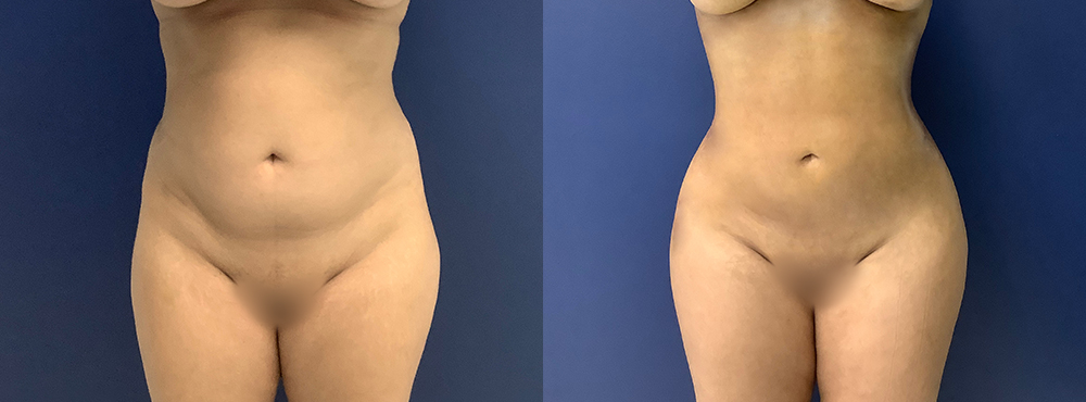 BBL Before and After