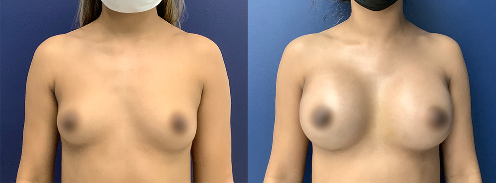 Breast Augmentation Before and After