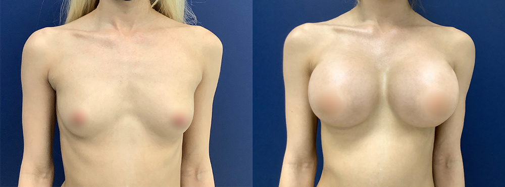 Breast Augmentation Before and After