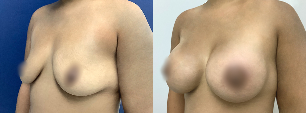 Breast Augmentation Before and After