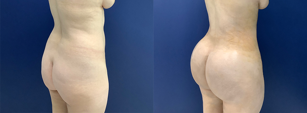 BBL Before and After