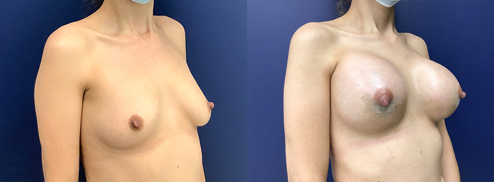 Breast Augmentation Before and After