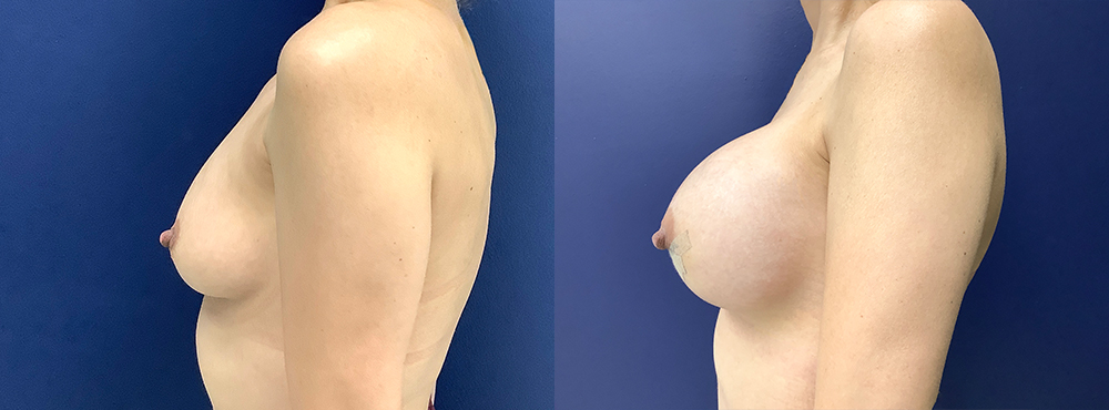 Breast Augmentation Before and After