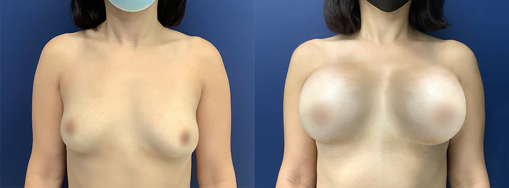 Breast Augmentation Before and After