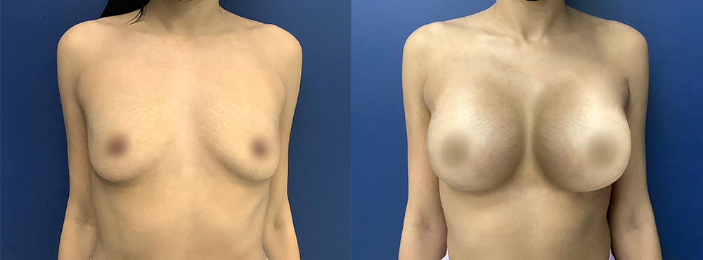 Breast Augmentation Before and After