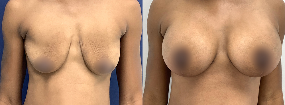 Breast Lift Before and After