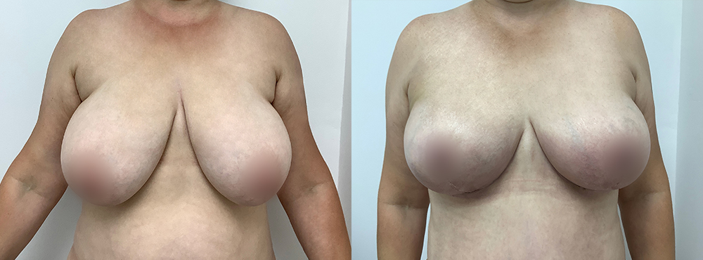 Breast Reduction Before and After