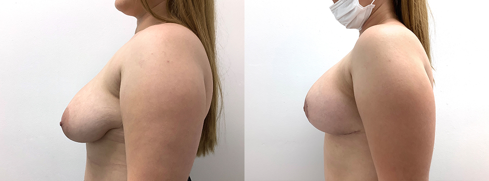 Breast Lift Before and After