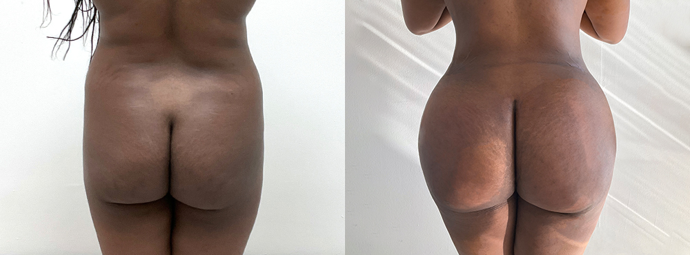 BBL Before and After