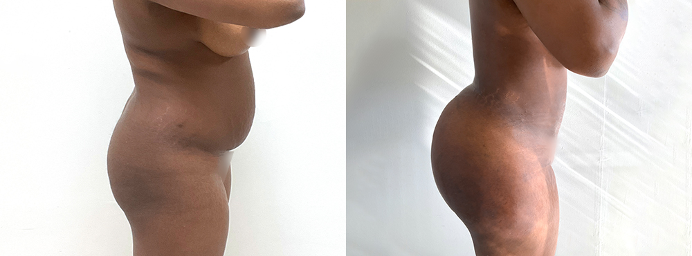 BBL Before and After