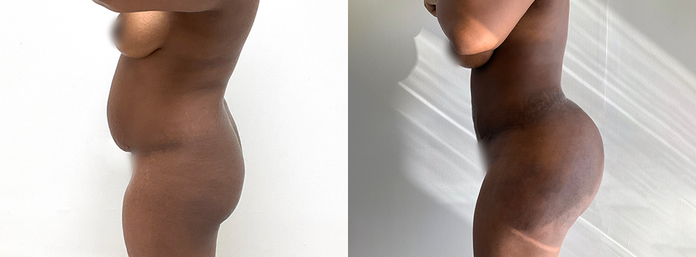 BBL Before and After